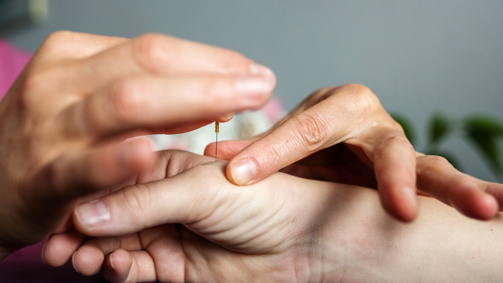 Acupuncture